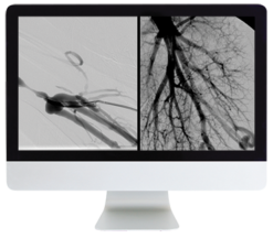 ARRS Case Review of Vascular and Interventional Radiology 2023